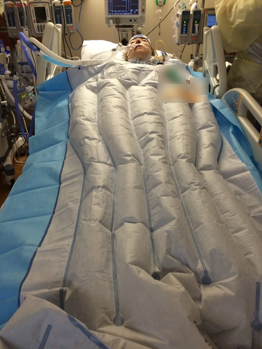 Rebecca in an ICU bed covered by a large inflatable warming blanket, surrounded by monitors and IV pumps.